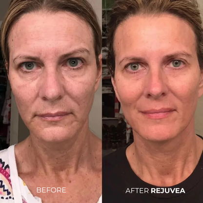 Rejuvea Micro Infusion System™