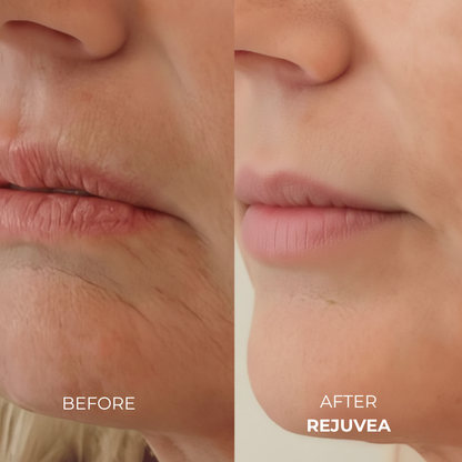 Rejuvea Micro Infusion System™