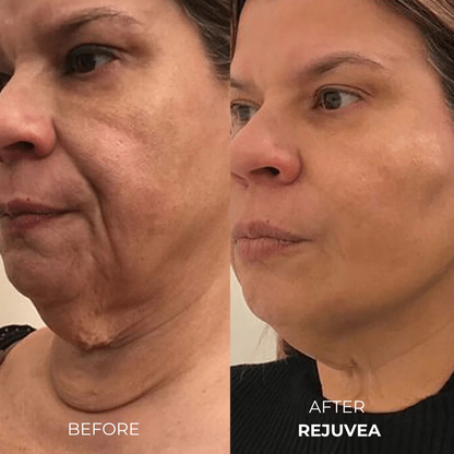 Rejuvea Micro Infusion System™