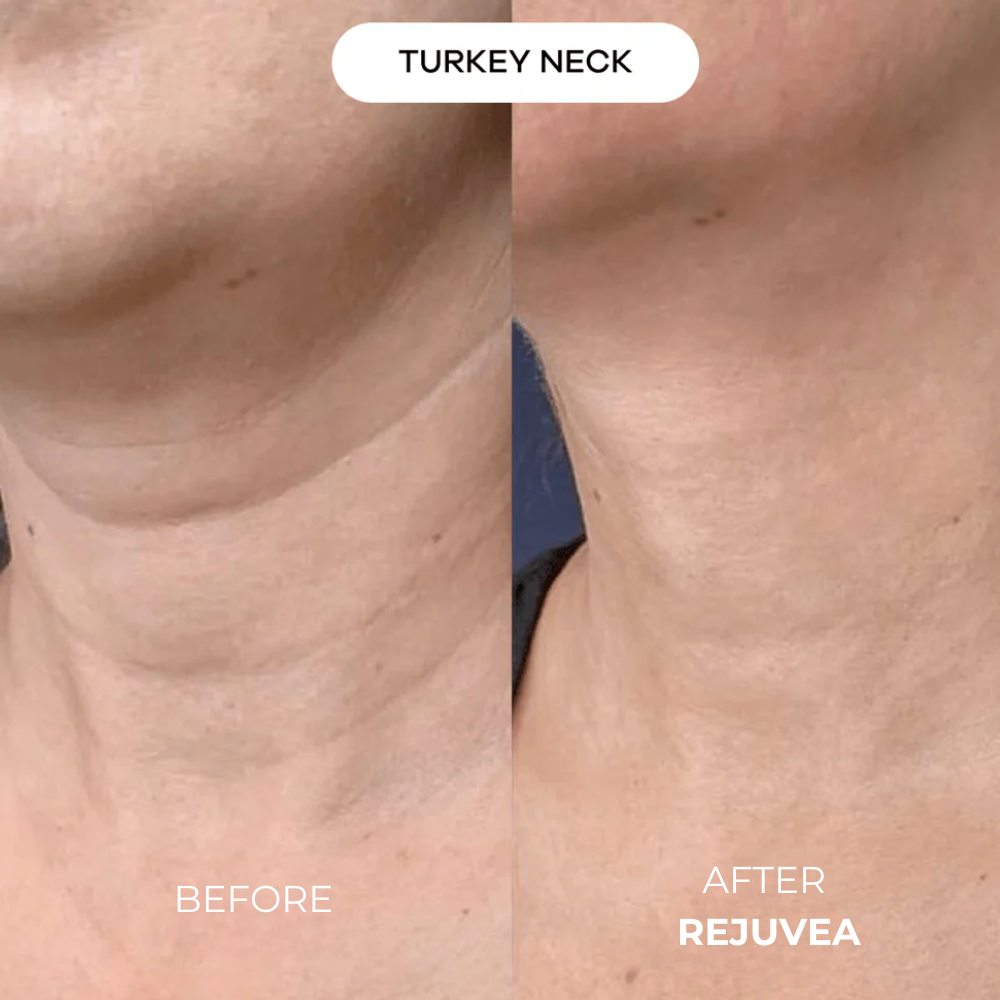 Rejuvea Micro Infusion System™